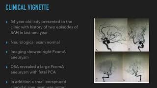 Management of Pcom aneurysm in the presence of fetal variant of PCA [upl. by Lehteb435]