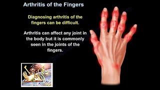 Arthritis Of The Fingers  Everything You Need To Know  Dr Nabil Ebraheim [upl. by Gisella]