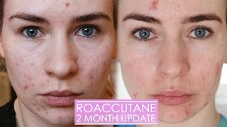 2 MONTH ROACCUTANE UPDATE  Side effects amp my skin now [upl. by Auoz]