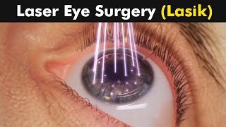 How Laser Eye Surgery Lasik is Performed  3D Animation UrduHindi [upl. by Adamik]