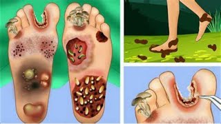 ASMRathletes foot hand finger maggot between toes picturesinfection removal ANIMATIONS [upl. by Giark]