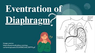 Eventration of Diaphragm Causes Symptoms and Treatment  Novice Medic [upl. by Lareine688]