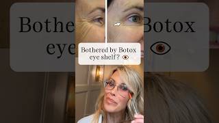 Botox Eye Shelf botox beauty filler [upl. by Iroc]