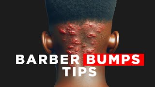 Tips To Treat Pimples on Back of headNeck  Acne Keloidalis Nuchae [upl. by Silloh669]