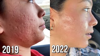 Microneedling Session 8 Before  After [upl. by Mckenzie]