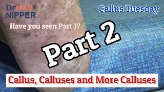 Callus Calluses and More Calluses on Left Foot  Part 2 Callus Tuesday 2020 [upl. by Llig273]