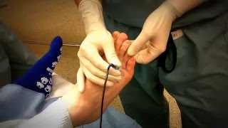 Radiofrequency Ablation For Painful Neuroma [upl. by Brenza40]