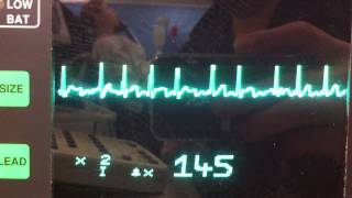 Atrial fibrillation ECG [upl. by Ahsaercal673]