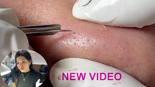 Acne Treatment Huong Da Nang599  2024 [upl. by Moll]