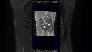 😱subchondral cyst in tibial plateau ytshortsytshortsviralviralradiologytrendingshortmrimri [upl. by Witty155]