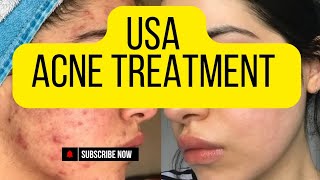 Top Acne Treatment Tips for Clear SkinUnited States Acne Treatment [upl. by Elleoj]