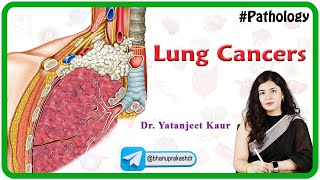 Lung Cancers Pathology In Hindi  Benign and Malignant   MBBS USMLE Neet PG and FMGE [upl. by Neelyhtak]