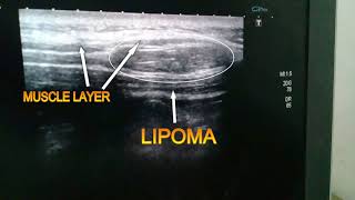 interintramascular lipoma ultrasound video [upl. by Prestige]