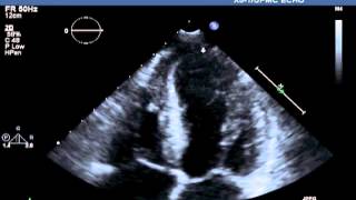 Transthoracic Echocardiographic Images Obtained after Cardiac Catheterization [upl. by Ethelstan]