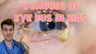 Doctor explains 4 causes of eye pus discharge or sticky eyes in kids  Doctor ODonovan [upl. by Nine274]