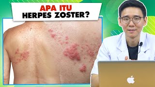 Apa Itu Herpes Zoster Atau Cacar Api [upl. by Gustafson]