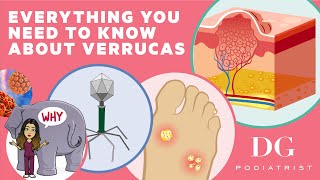 Everything you need to know about verrucas [upl. by Ardnasac963]