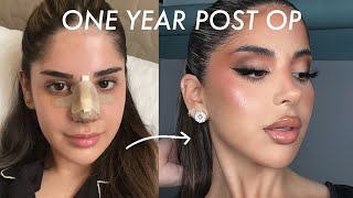 1 YEAR POST OP NOSE JOB UPDATE  QampA [upl. by Eltsyek]