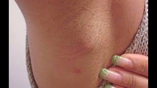 Home Remedies for Hidradenitis Suppurativa [upl. by Neeluj533]