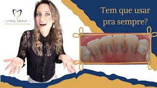 Contenção inferior pra sempre😰 shorts aparelho contenção [upl. by Nage257]