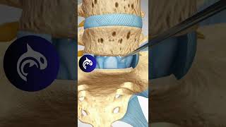 See how an Artificial Lumbar Disc Replacement works 3D backpain chronicpain spine [upl. by Asilana79]