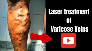 Laser treatment of varicose veins Result of varicose veins treatment by Dr Pankaj Kumar [upl. by Tepper]