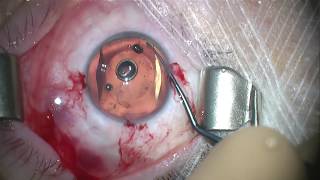 Chirurgie implant phake myopique ICL [upl. by Fendig214]