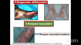 🔴Hématologie Pathologies de lhémostase [upl. by Leuqram812]