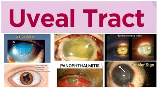 Uveal Tract 4Last Minor Topic Panophthlamitis [upl. by Assirat]