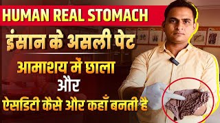 FullVideoAcidity amp Gastric Ulcer in Real Stomach  इंसान के असली पेट में ऐसिडिटी और छाले viral [upl. by Petronilla]