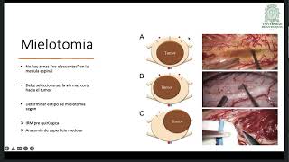 Técnica quirúrgica en astrocitoma medular [upl. by Pudendas]