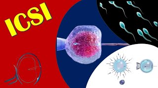 ICSI  Intracytoplasmic Sperm Injection [upl. by Sherurd562]