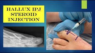 Injection  hallux IP jt steroid injection [upl. by Baten]