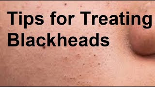 Tips for Treating Blackheads [upl. by Okihsoy]