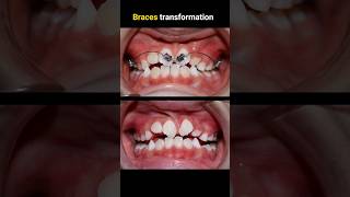 BRACES journey transformation braces orthodontist dentistry [upl. by Heathcote]