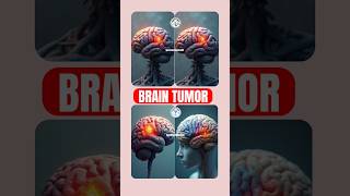 quotBrain Tumor Awareness Symptoms Diagnosis and Treatmentquot By OperationTheatreSKR BrainTumour [upl. by Hanzelin]