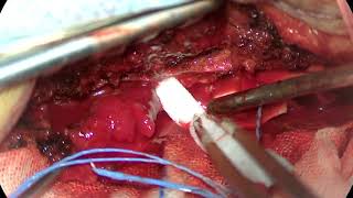 Surgical Resection of Spinal Angiolipoma Surgical Technique and Case Presentation [upl. by Ruomyes]