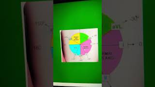 Left axis deviation in ECG [upl. by Shien781]