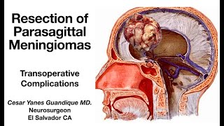 INTRAOPERATIVE COMPLICATIONS IN THE RESECTION OF PARASAGITTAL MENINGIOMAS [upl. by Bronson784]