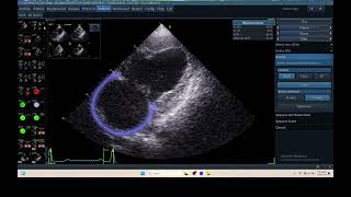 IQ 306 AFI LA ECHOPAC ANALYSIS HEPATOMA PTE ECHOCARDIOGRAPHY 2 [upl. by Alfreda]