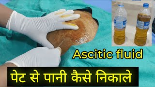 Ascites Fluid tapping Procedure  Dr Subodh SKP [upl. by Atterrol]