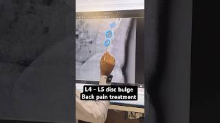 L4  L5 disc bulge chiropractic treatment trending shortfeed trend [upl. by Ainegue]