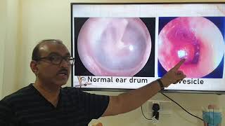 Bullous Myringitis Tamil Patient teaching programme [upl. by Trumann]