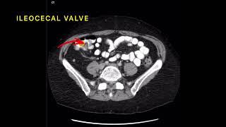 tkr ana 14 HOW TO APPROACH DUODENUM ASCENDING COLON ILEOCECAL VALVE amp APPENDICEAL ORIFICE🚦 [upl. by Anelleh831]