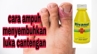 Cara ampuh menyembuhkan cantengan  cara ampuh menyembuhkan luka di jari kaki [upl. by Atirehc993]