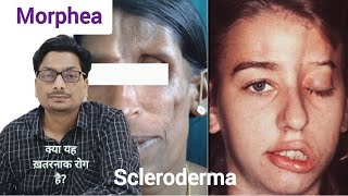 Morphea  Localized Scleroderma क्या यह ख़तरनाक बिमारी है morphea scleroderma systemicsclerosis [upl. by Kacie475]