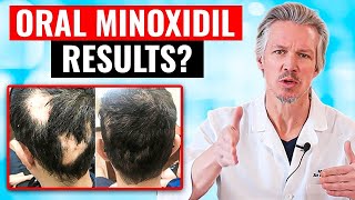 20000 PEOPLE TOOK ORAL MINOXIDIL AND THIS HAPPENED [upl. by Marve]