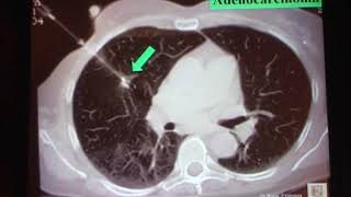 15 Neoplasie del Polmone Le biopsie polmonari Giancarlo Bosio [upl. by Eiramnerual207]
