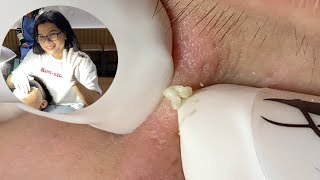 Acne Treatment Huong Da Nang604  2024 blackheads [upl. by Maighdlin184]