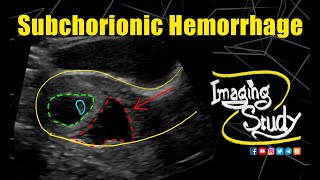 Subchorionic Hemorrhage  Ultrasound  Case 258 [upl. by Limann436]